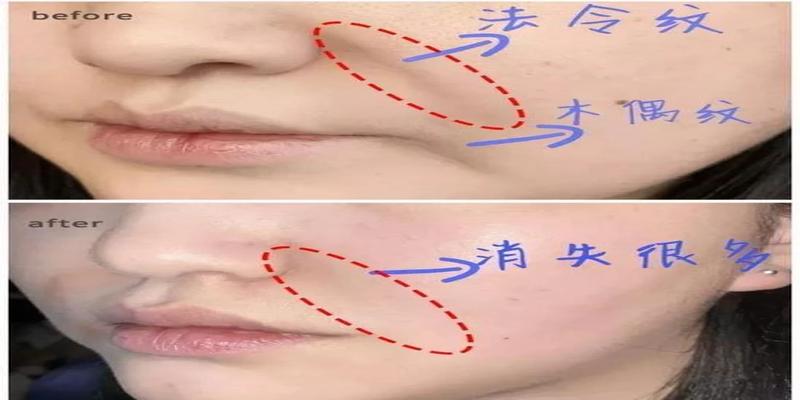 鼻唇沟太深怎么办,鼻唇沟在哪_文秘苑图库