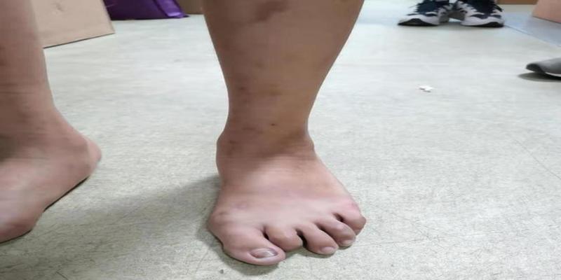 足外翻引起的外八有韧带松弛副舟骨倾斜距骨生理性足外翻等不过外八不