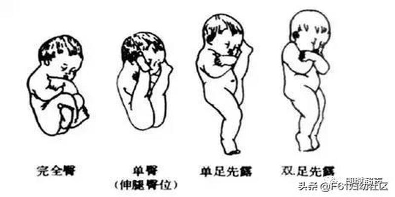超声图像方位讲解图如何通过超声辨别胎方位