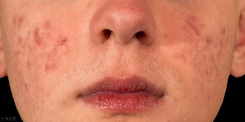 额头正中间长痘痘风水不同部位长痘痘