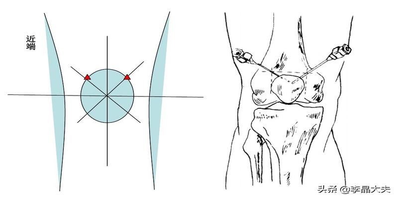 为穿刺点针头与胫骨平台平行向内呈45度角与矢状面呈45度角穿刺进入针