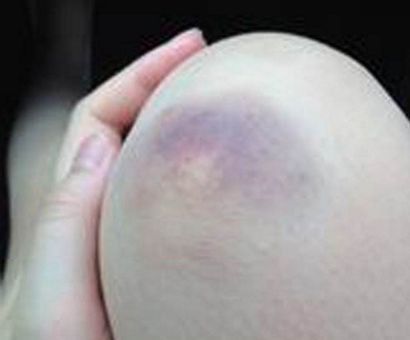 挫伤由钝器机械力摩擦引起,表现出表皮破损,抓痕,擦痕,压痕等,但真皮